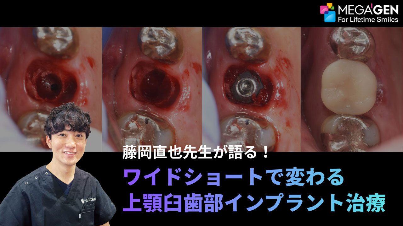 侵襲度が高いサイナスリフトに革命？！ワイドショートで変わる上顎臼歯部インプラント治療の画像です。