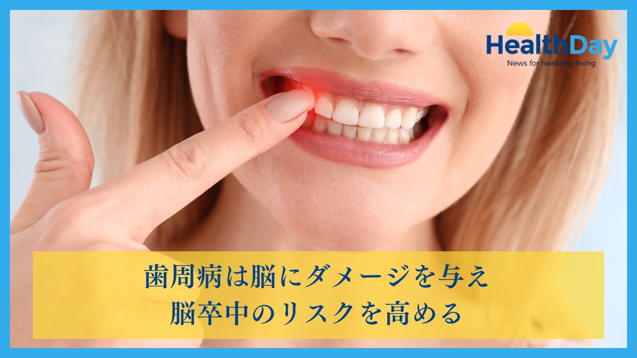 歯周病は脳にダメージを与え脳卒中のリスクを高めるの画像です。