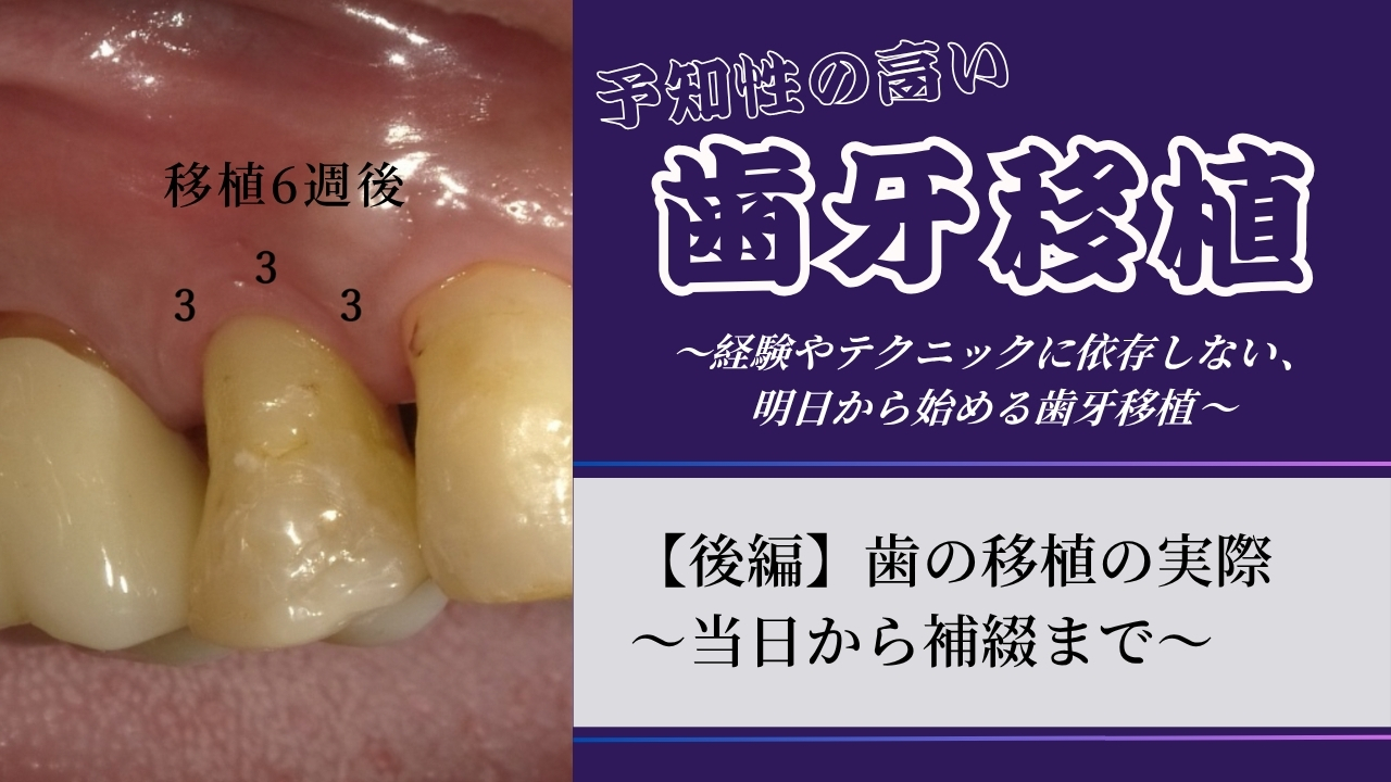 予知性の高い歯牙移植〜経験やテクニックに依存しない、明日から始める歯牙移植~③【後編】歯の移植の実際~当日から補綴まで~の画像です。