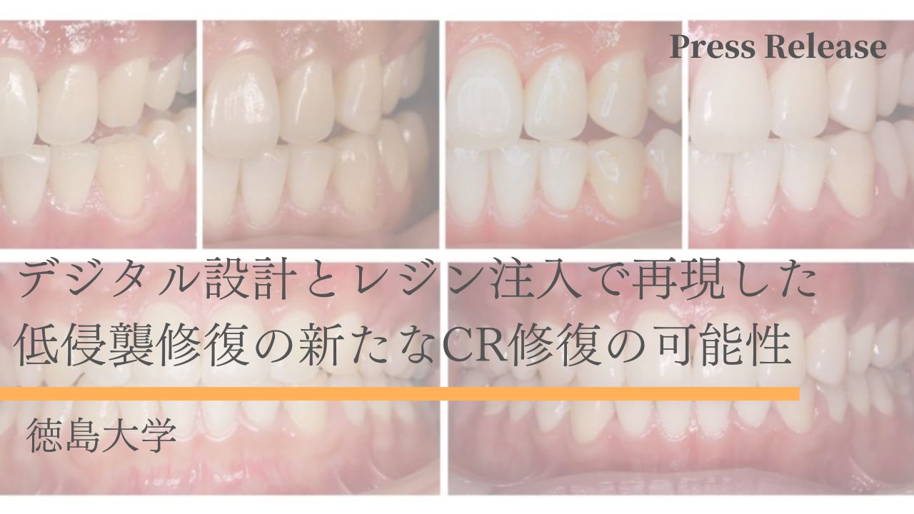 デジタル設計とレジン注入で再現した低侵襲修復の新たなCR修復の可能性　徳島大学の画像です。