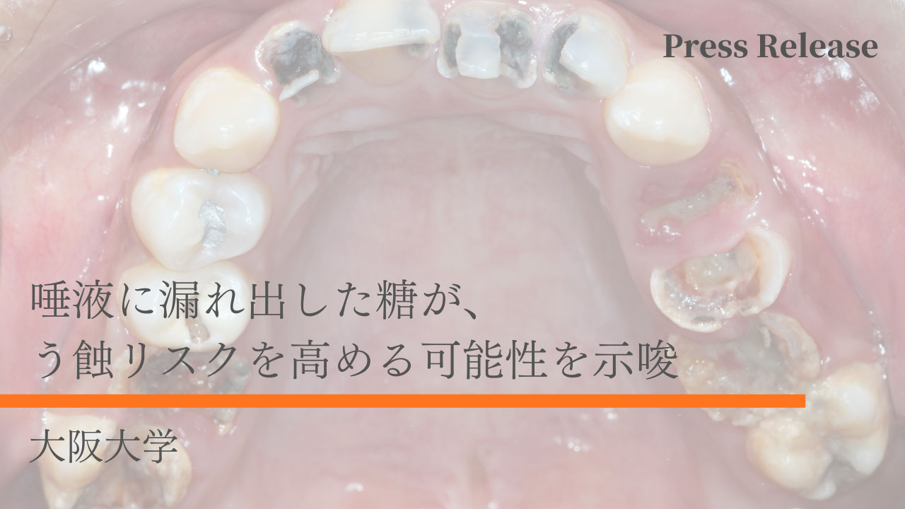 唾液に漏れ出した糖が、う蝕リスクを高める可能性を示唆　大阪大学の画像です。