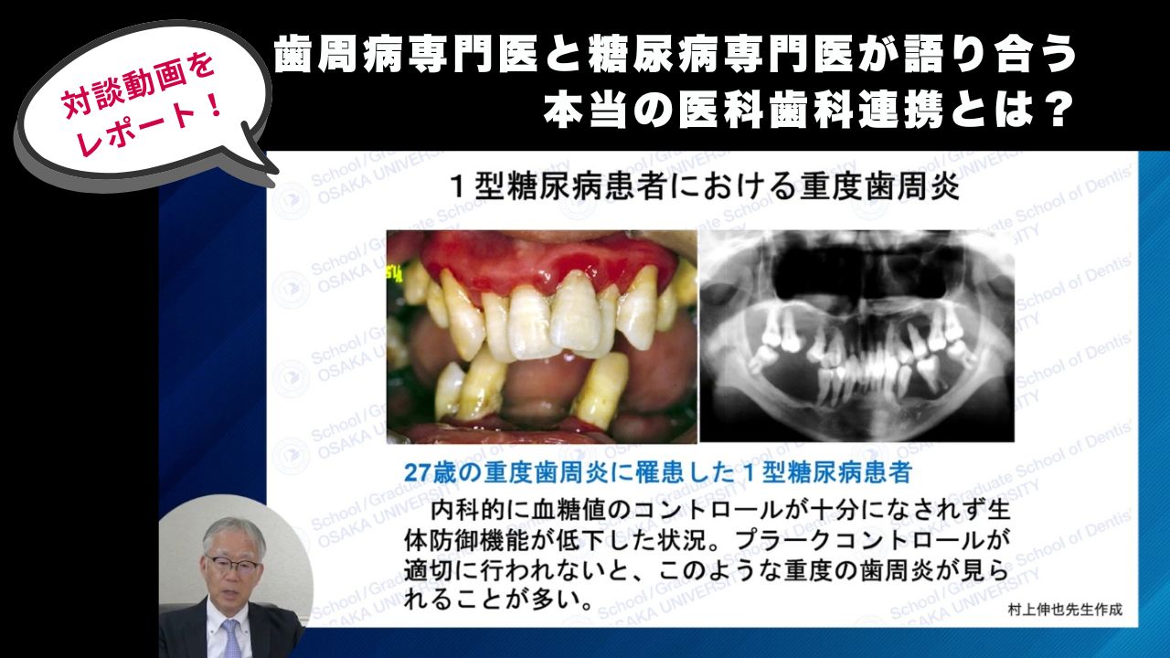 【対談動画をレポート！】歯周病専門医と糖尿病専門医が語り合う本当の医科歯科連携とは？の画像です。