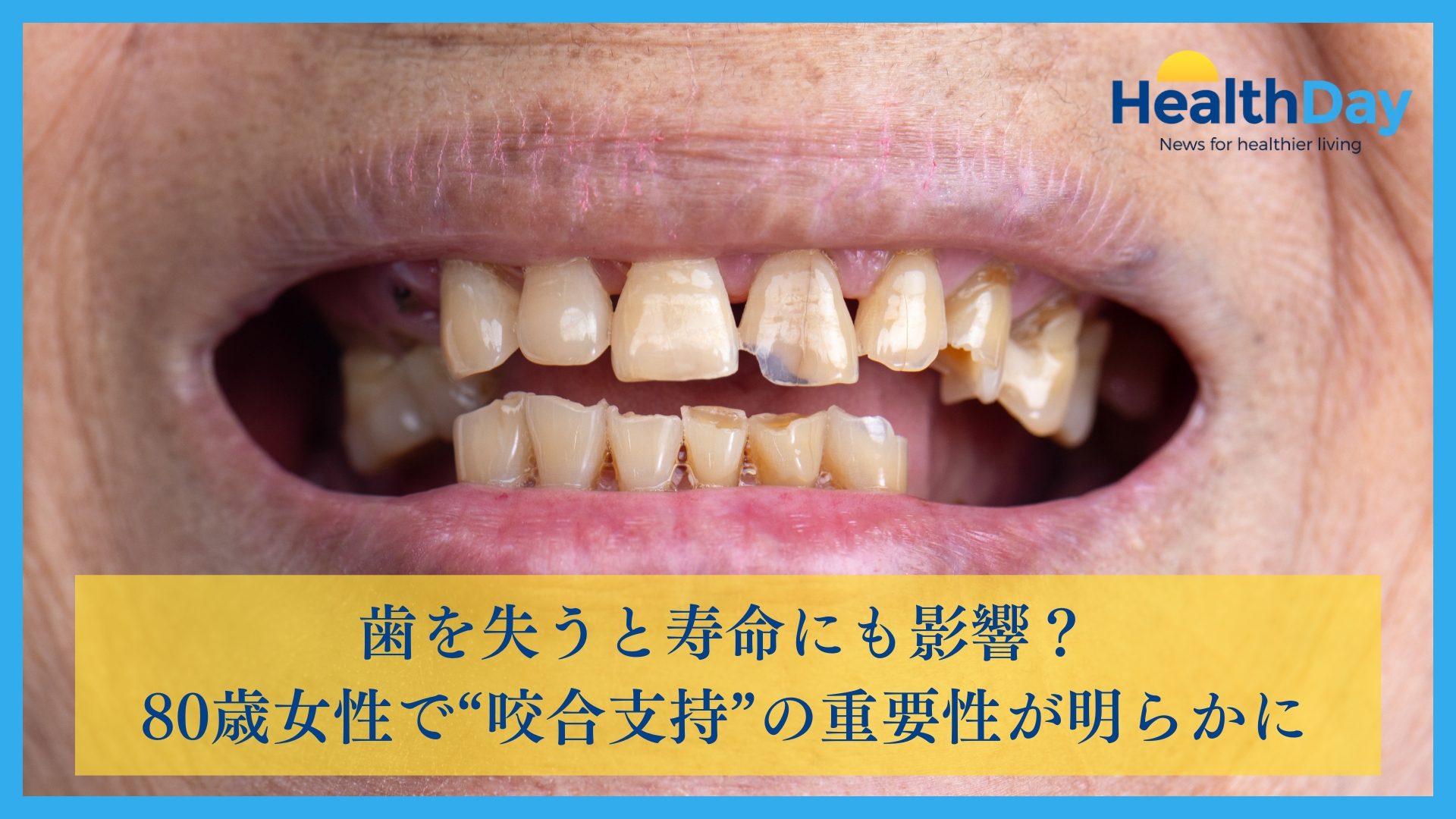 歯を失うと寿命にも影響？80歳女性で“咬合支持”の重要性が明らかにの画像です。