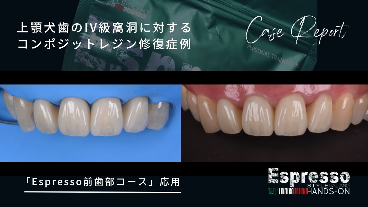 【Case report】上顎犬歯のIV級窩洞に対するコンポジットレジン修復症例の画像です。