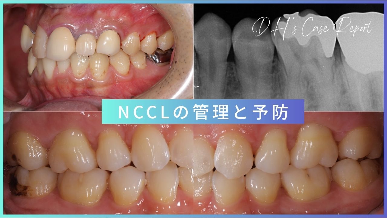 歯科衛生士のCase Report】NCCL（Non-Carious Cervical Lesion：非う蝕