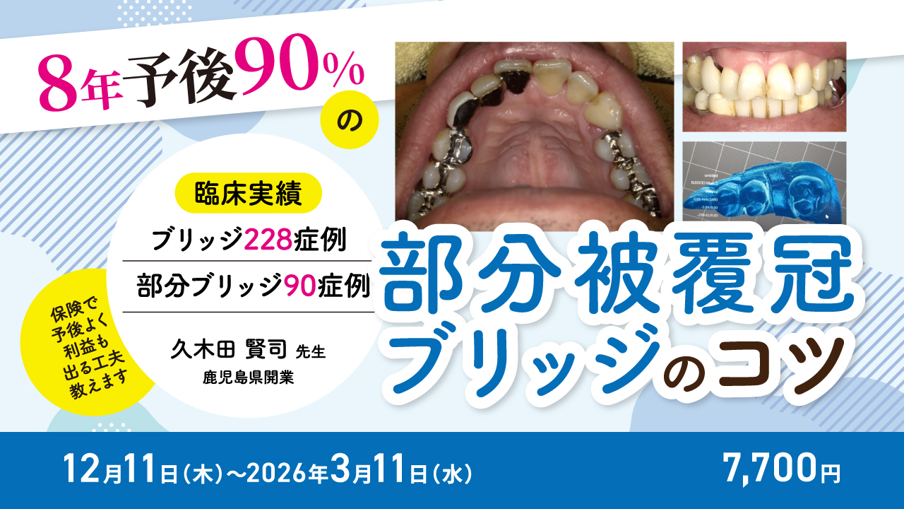 8年予後90%の部分被覆冠ブリッジのコツ〜保険で予後よく利益も出る工夫