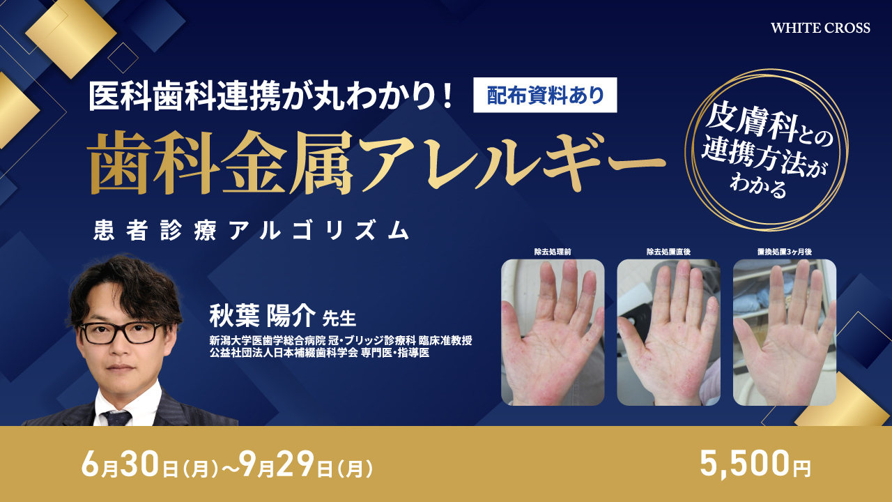 医科歯科連携が丸わかり！歯科金属アレルギー患者診療アルゴリズム