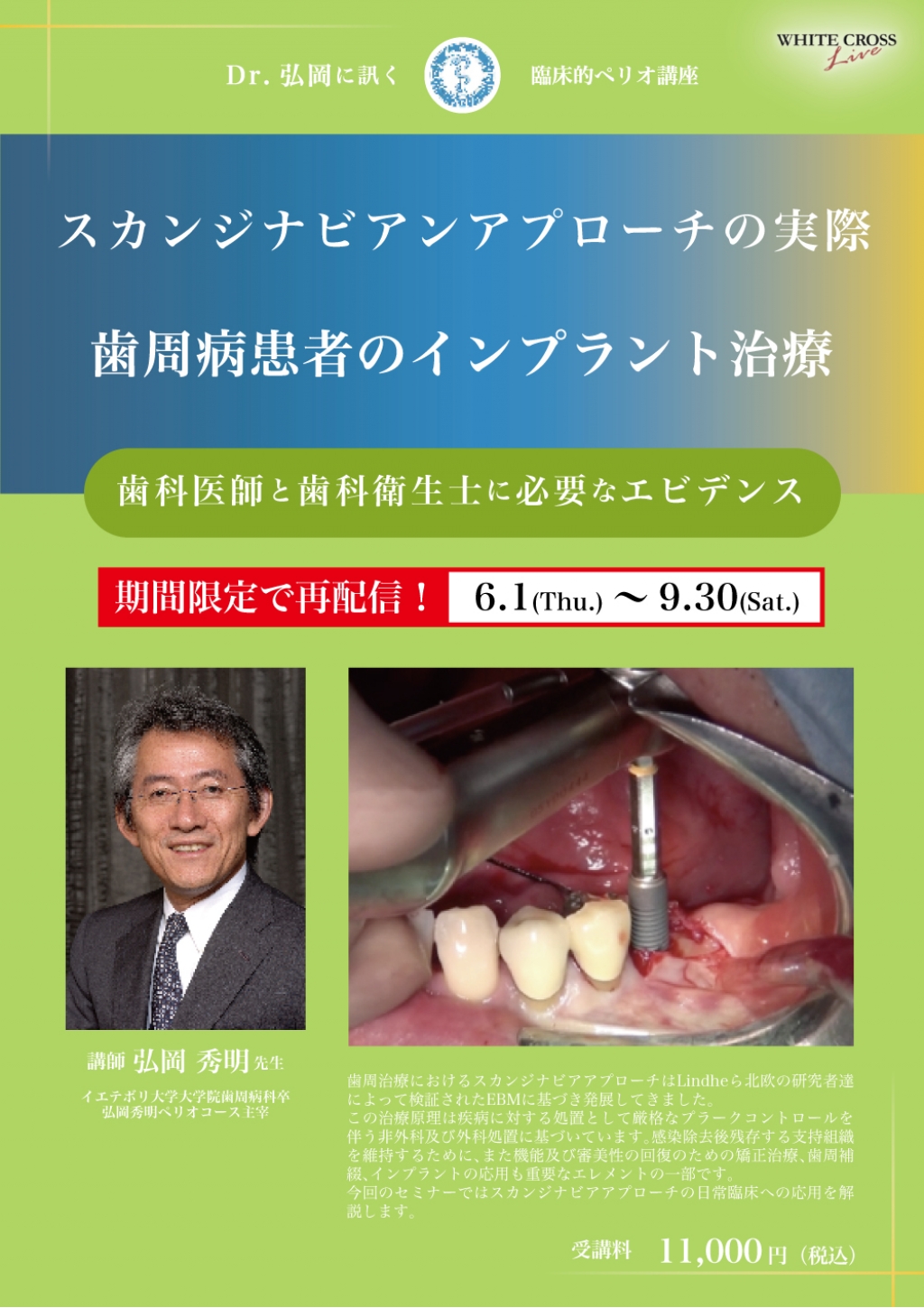 VOD］Dr.弘岡に訊く臨床的ペリオ講座 スカンジナビアンアプローチの