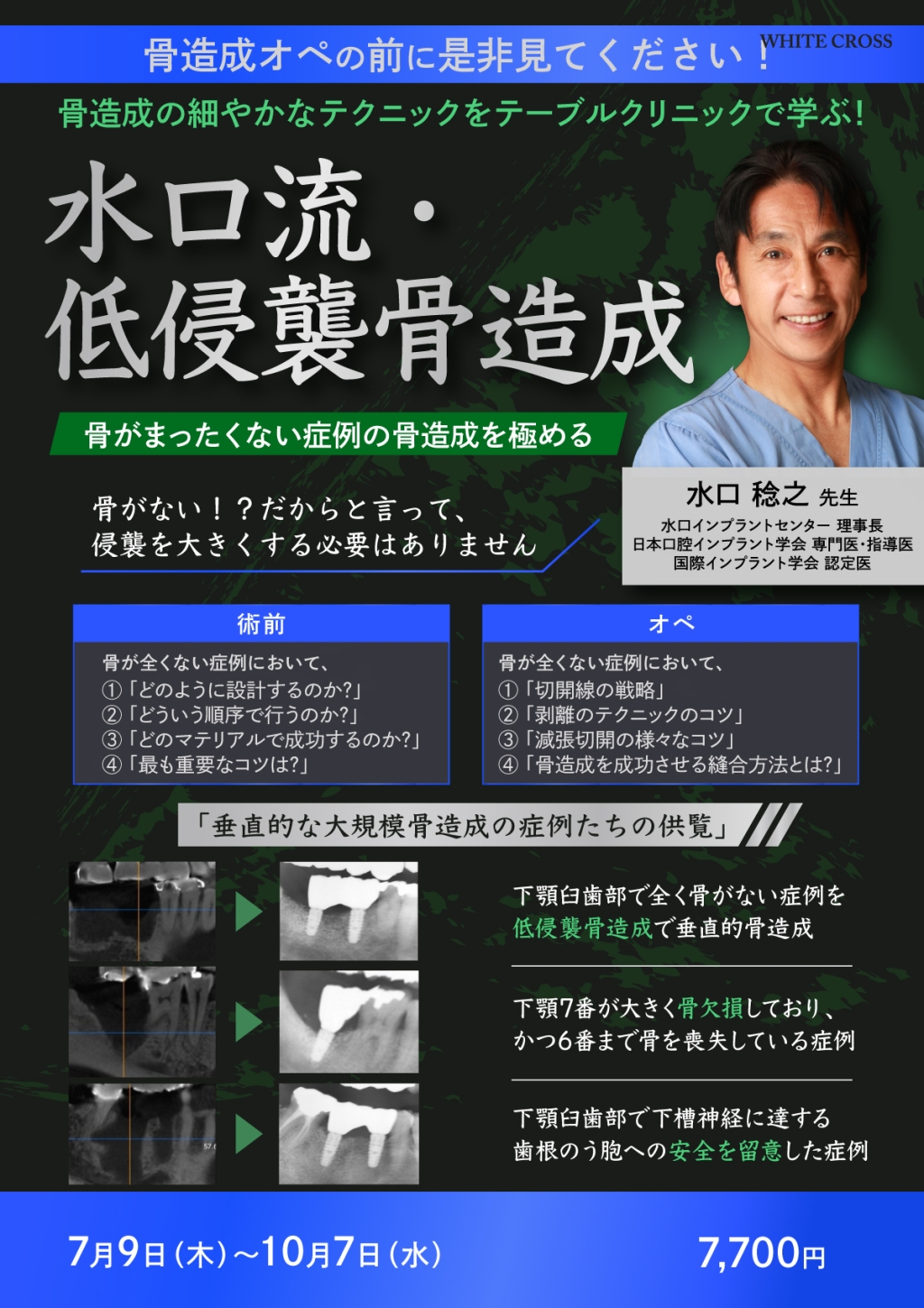 インプラント治療難症例攻略テクニック 水口稔之 インプラント治療 難