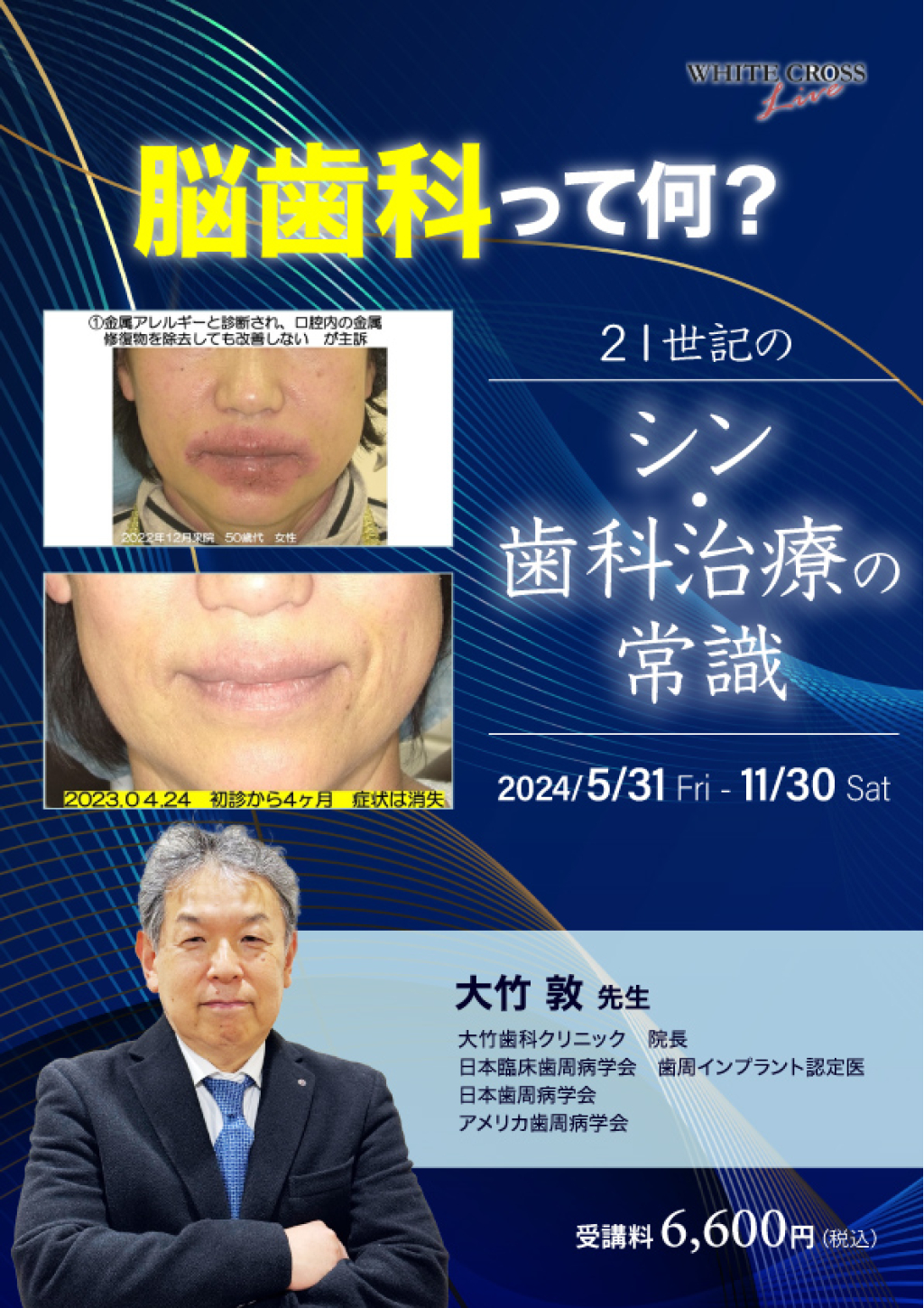 歯科　臨床歯周病学とインプラント　リンデ　英語版 Lindhe 臨床歯周病学とインプラント 第3版 基礎編