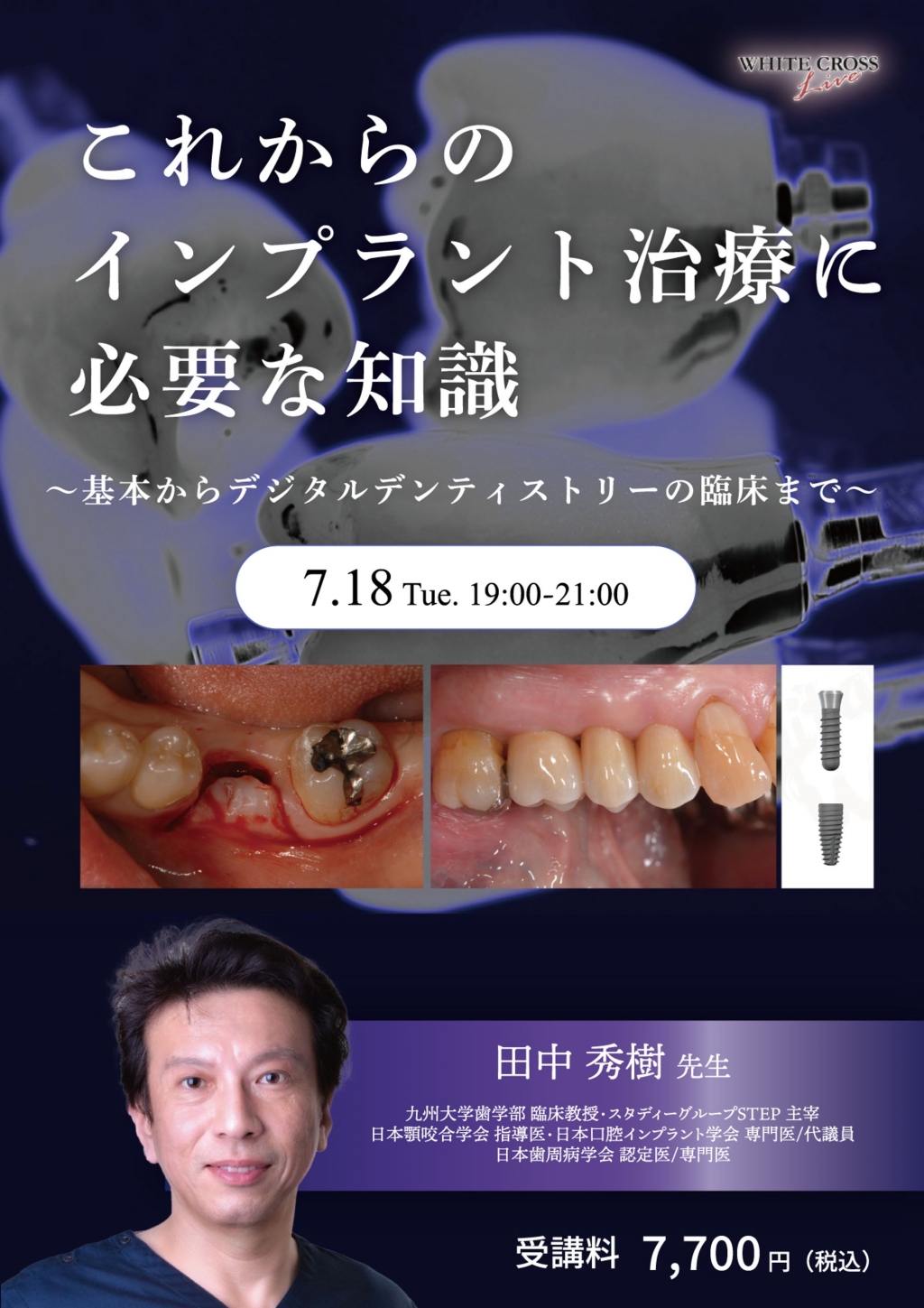 録画配信］これからのインプラント治療に必要な知識 | WHITE CROSS