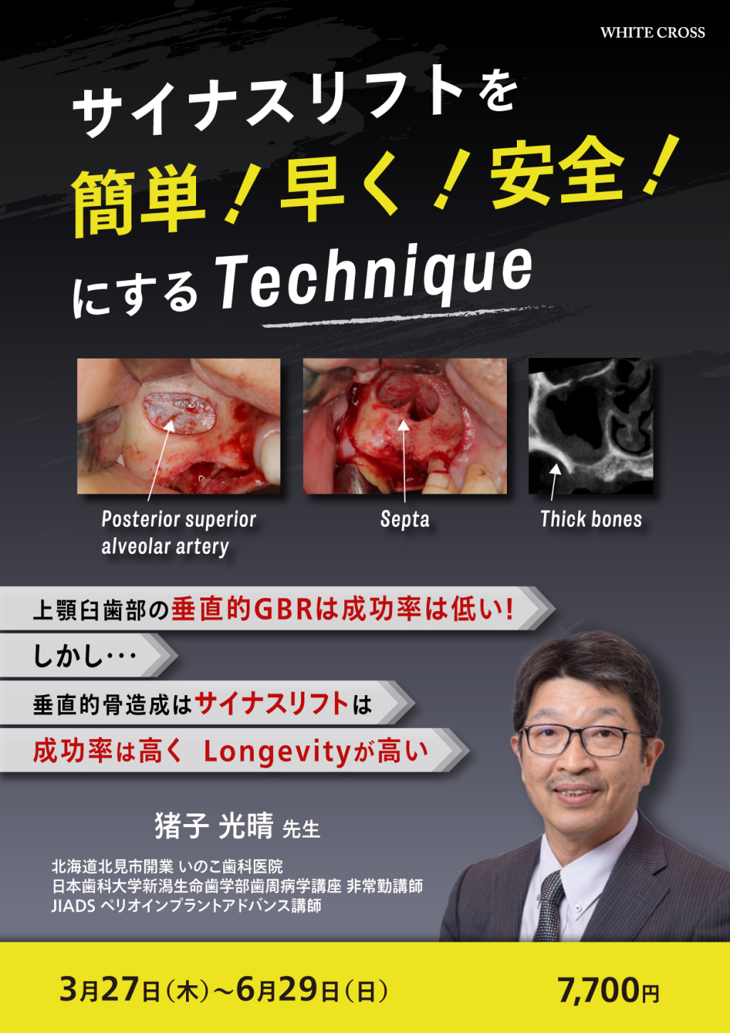 サイナスリフトを 簡単！ 早く！ 安全！にするTechniqueの画像です。