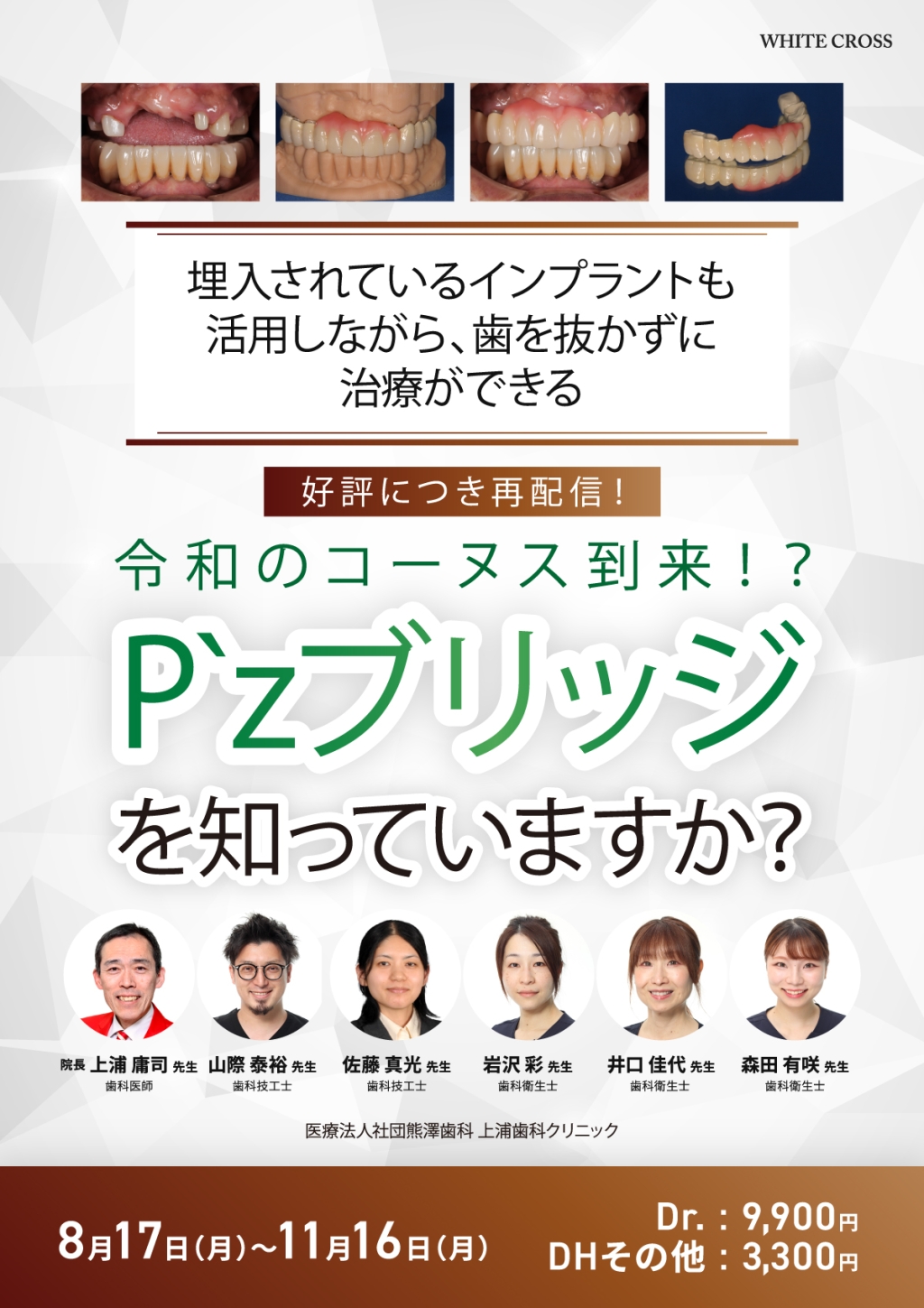 令和のコーヌス到来！？PZブリッジを知っていますか？【再配信