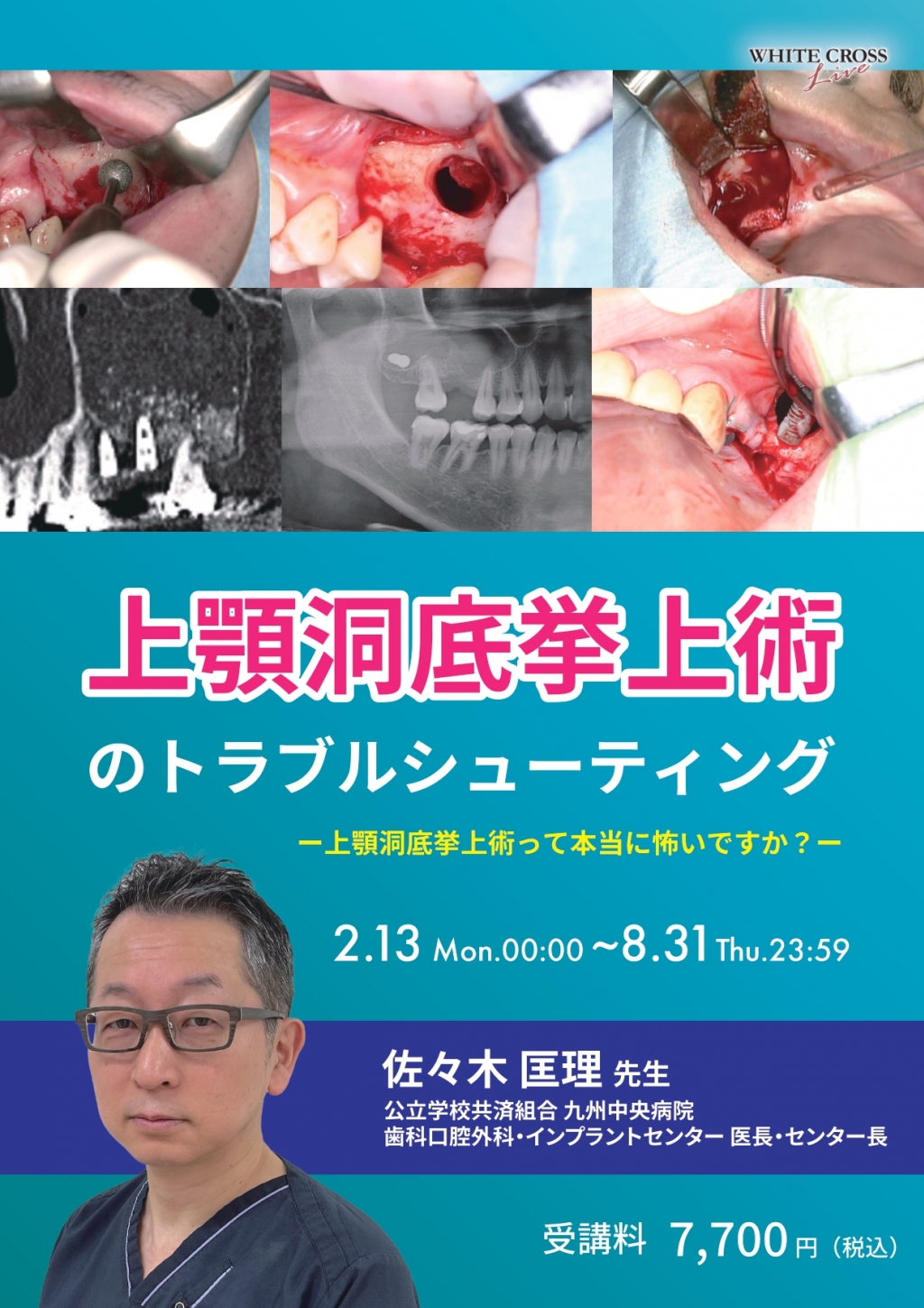 VOD］上顎洞底挙上術のトラブルシューティング | WHITE CROSS
