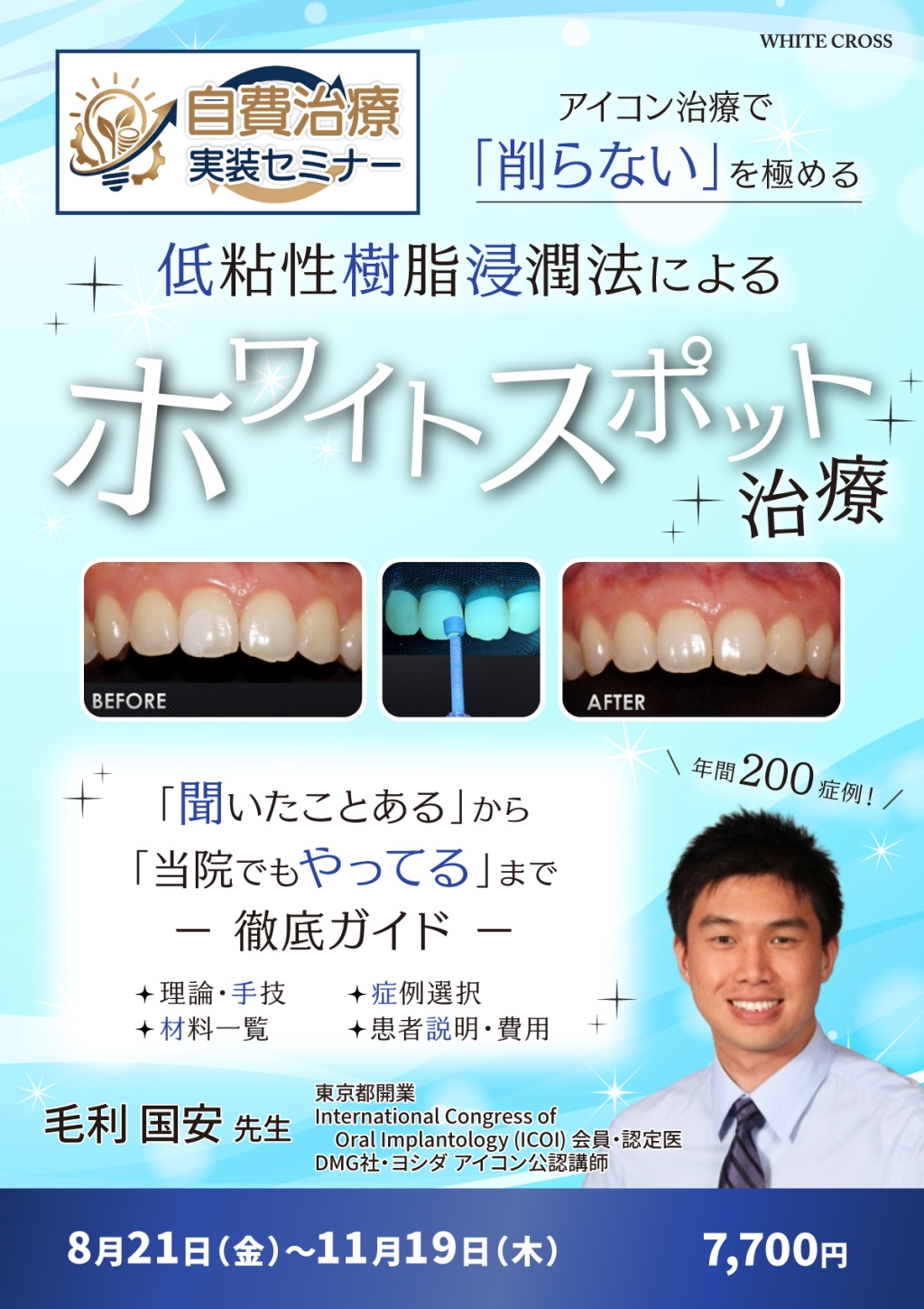 自費治療実装セミナー】低粘性樹脂浸潤法によるホワイトスポット治療