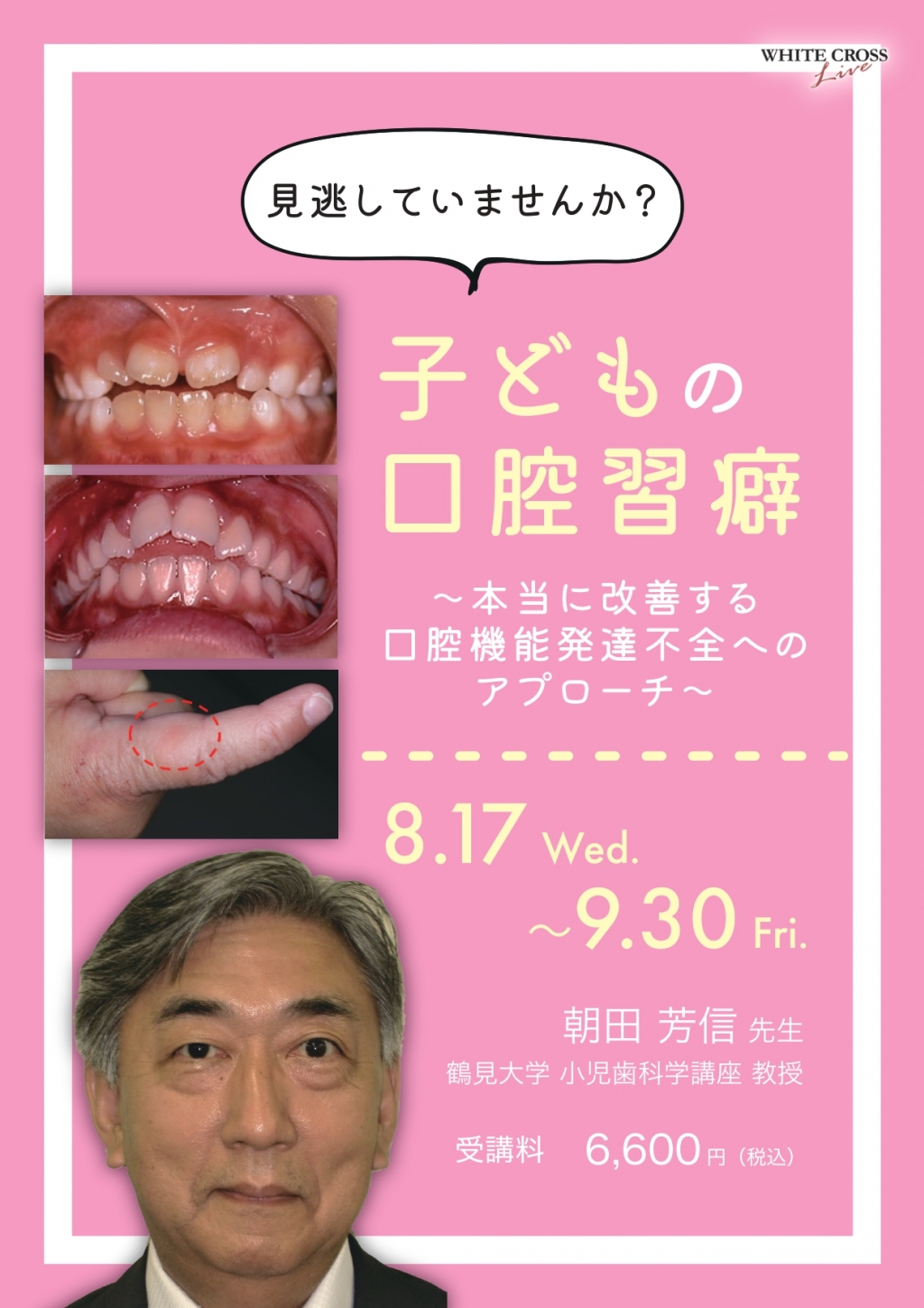 小児歯科学 VOD］見逃していませんか？子どもの口腔習癖 〜本当に改善する口腔機能