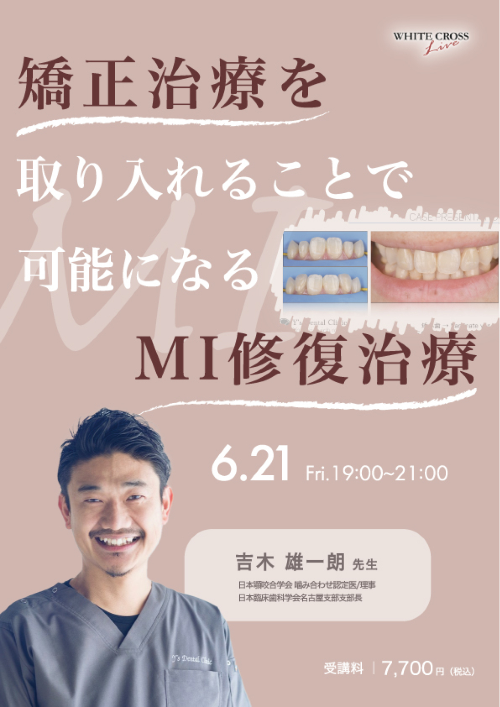 録画配信］矯正治療を取り入れることで可能になるMI修復治療 | WHITE CROSS