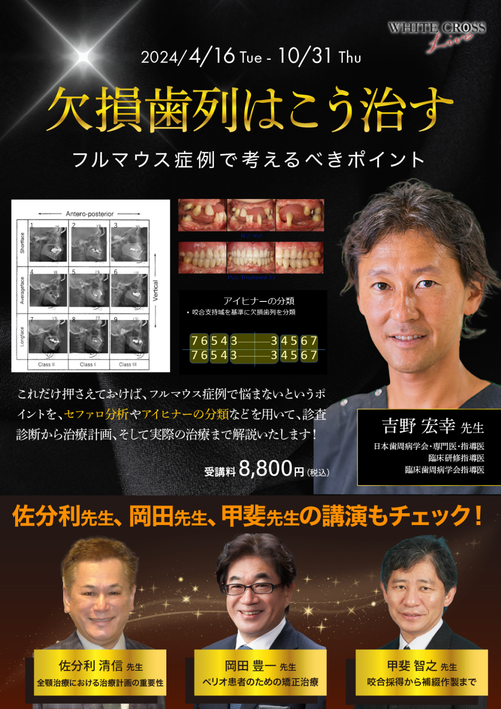 VOD］欠損歯列はこう治す〜フルマウス症例で考えるべきポイント