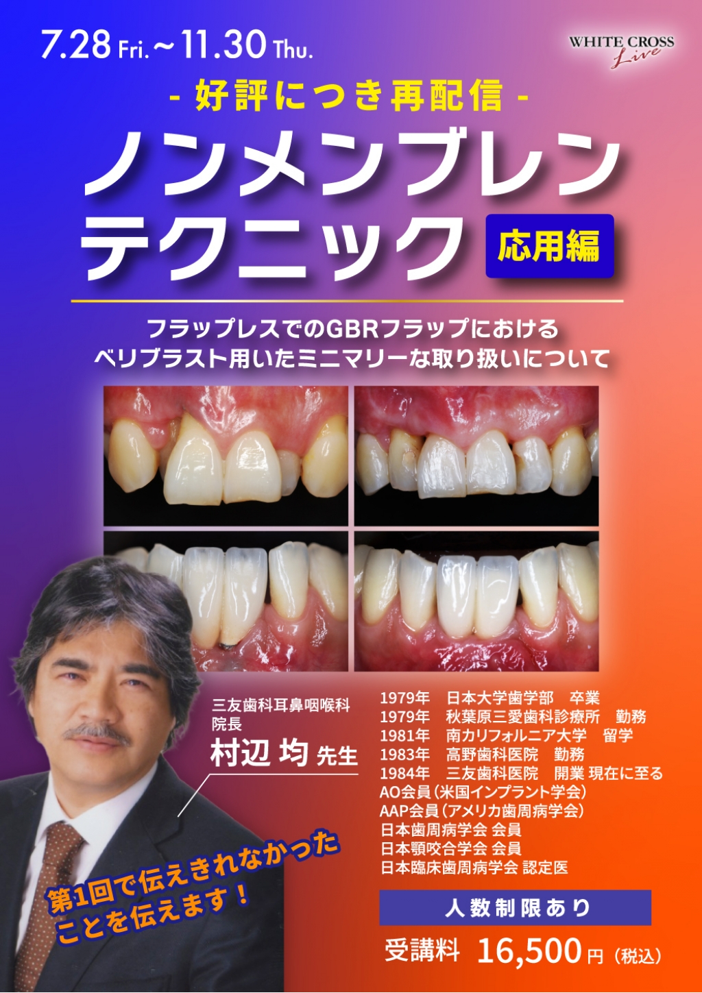 GBRの歯科インプラントへの応用 GBRの歯科インプラントへの応用
