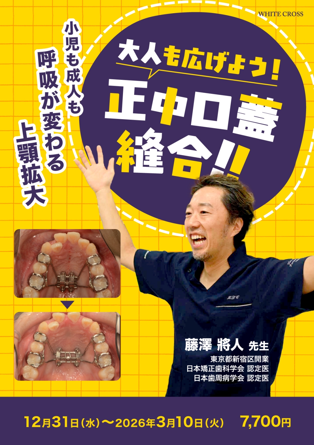 大人も広げよう！正中口蓋縫合！！の画像です。