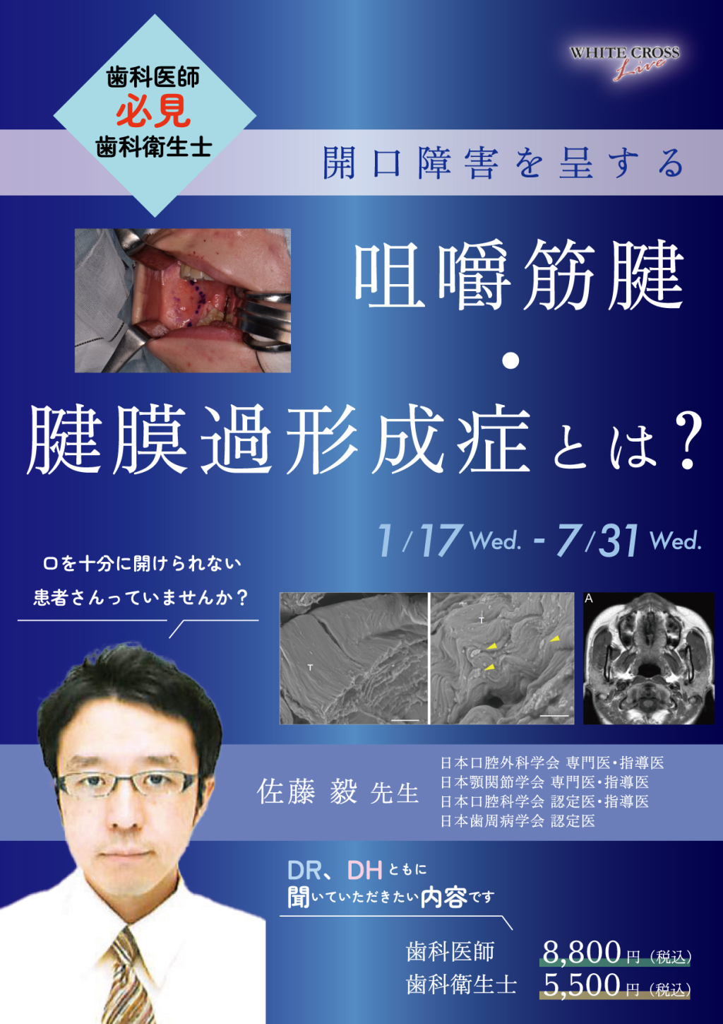 VOD］開口障害を呈する咀嚼筋腱・腱膜過形成症とは？ | WHITE CROSS