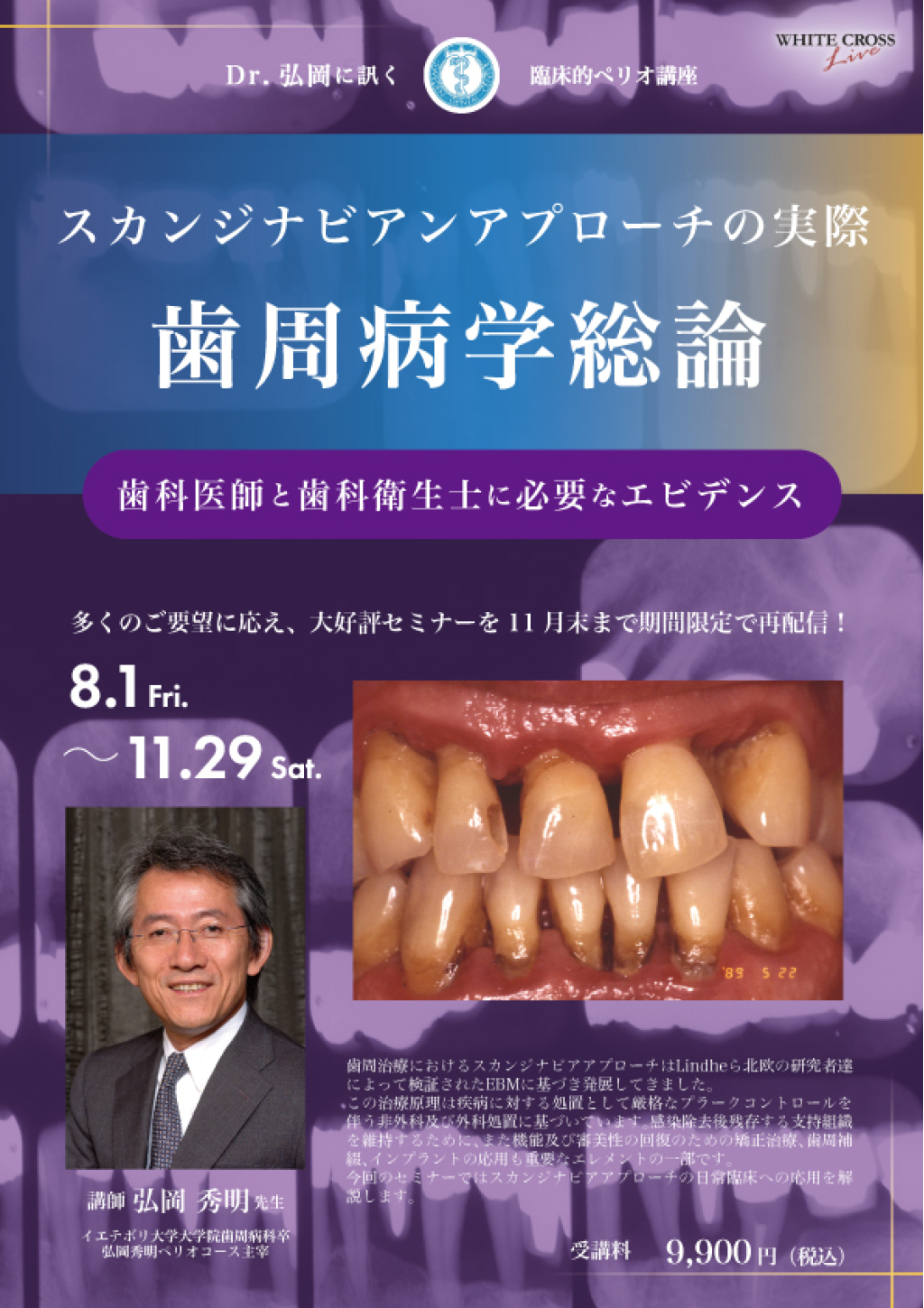 Dr.弘岡に訊く臨床的ペリオ講座　スカンジナビアンアプローチの実際〜歯周病学総論〜【再配信】の画像です。