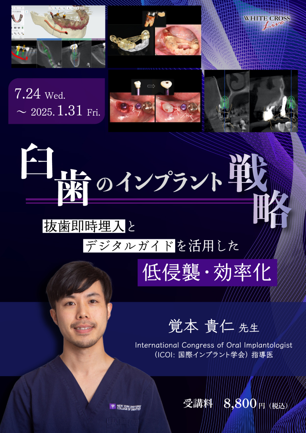 VOD］臼歯のインプラント戦略〜抜歯即時埋入とデジタルガイドを活用