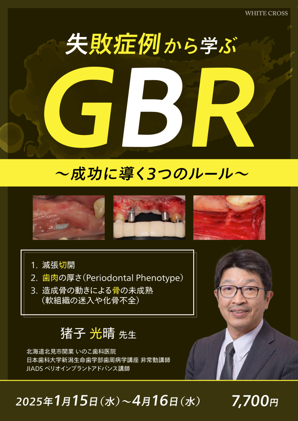 失敗症例から学ぶGBR～成功に導く3つのルール～の画像です。