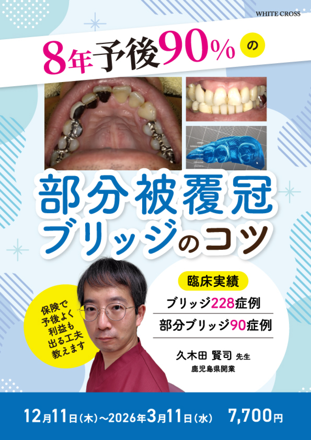 8年予後90%の部分被覆冠ブリッジのコツ〜保険で予後よく利益も