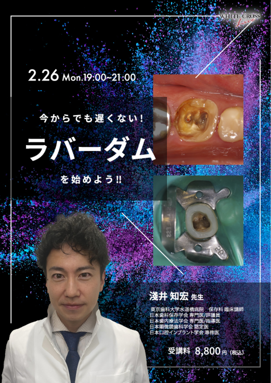 録画配信］今からでも遅くない！ラバーダムを始めよう！！ | WHITE CROSS