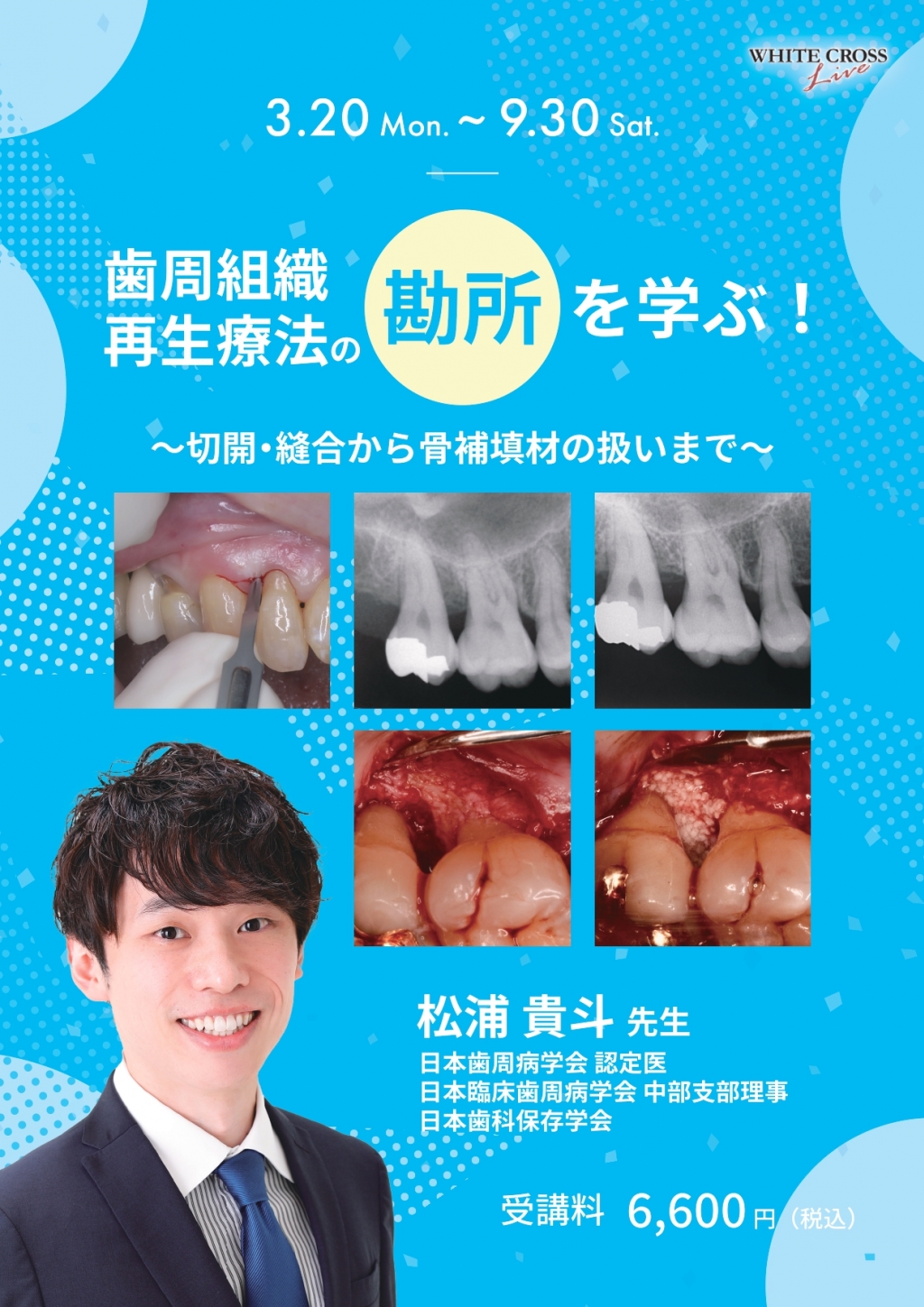 歯科再生・修復医療と材料 Mandibular Suction-Effective Denture “The Professional