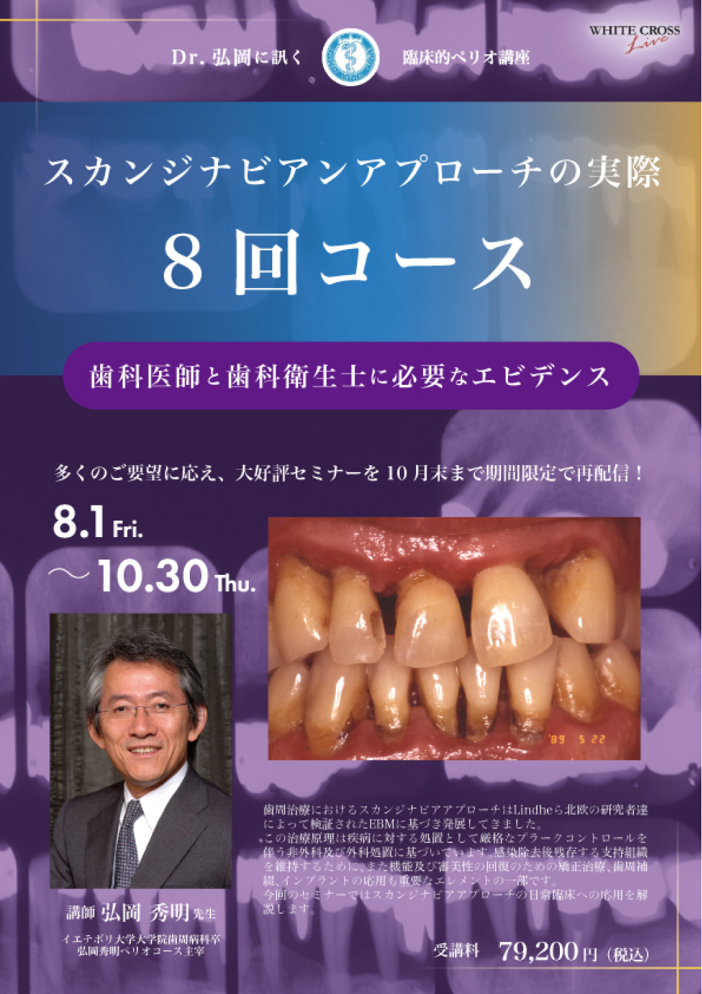 Dr.弘岡に訊く臨床的ペリオ講座 スカンジナビアンアプローチの