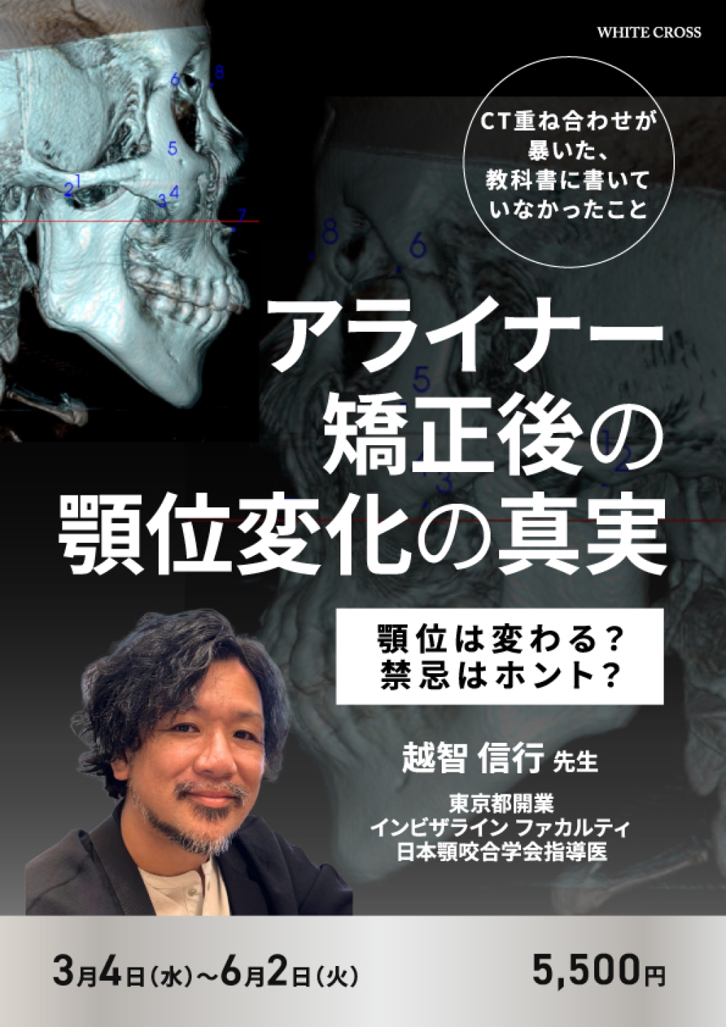 アライナー矯正後の顎位変化の真実〜CT重ね合わせが暴いた、教科書に