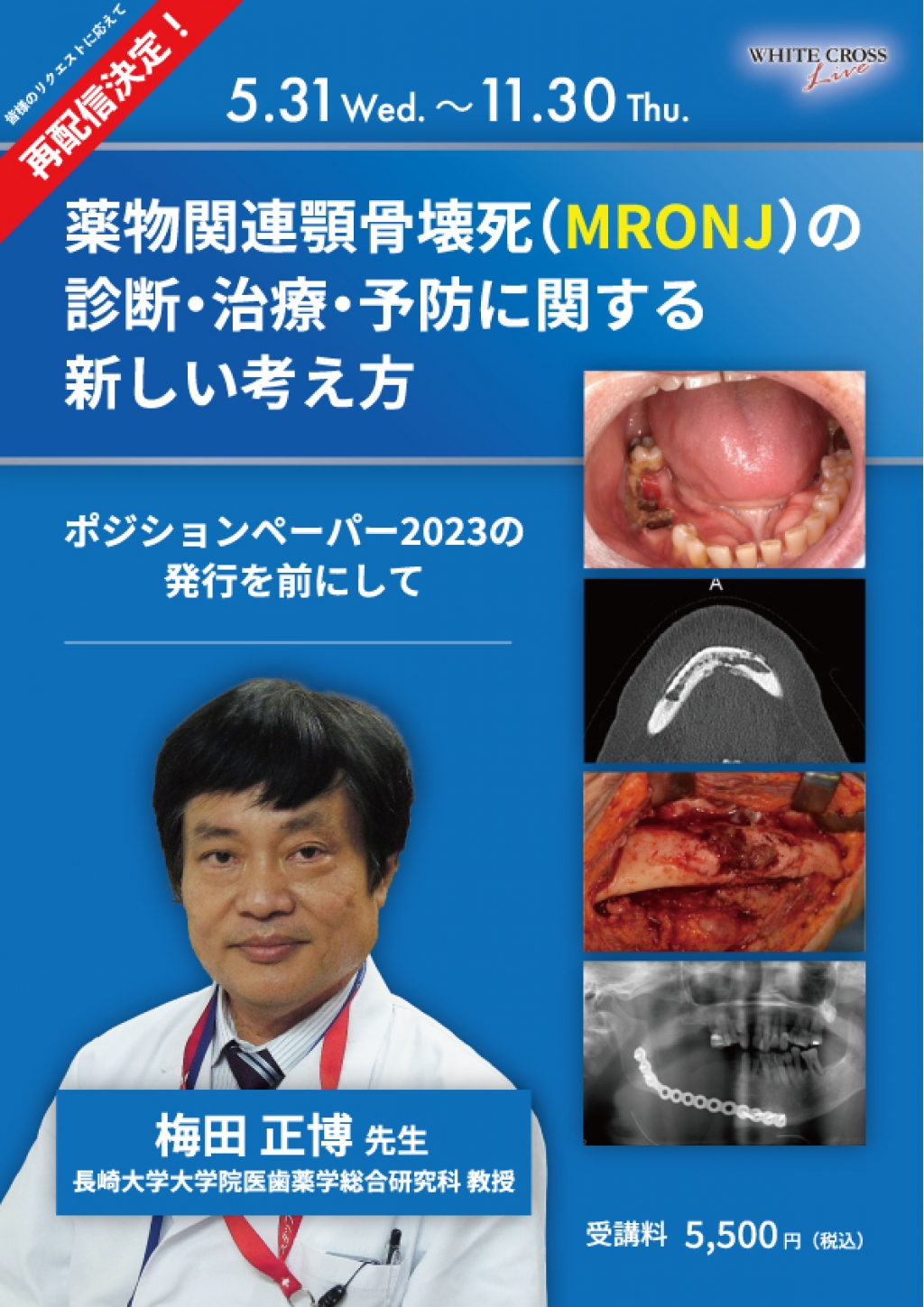 VOD］薬物関連顎骨壊死（MRONJ）の診断・治療・予防に関する新しい