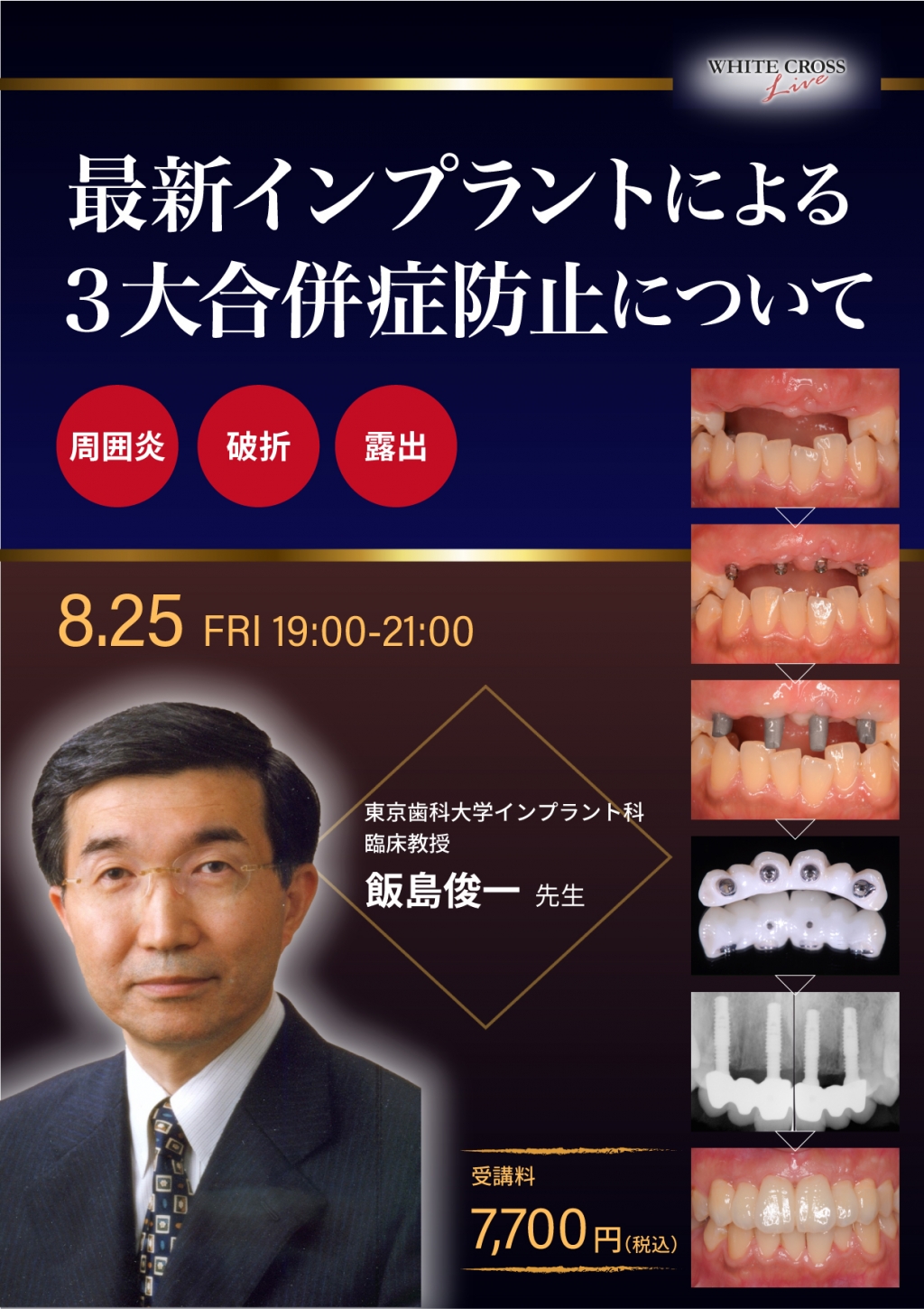 録画配信］最新インプラントによる3大合併症防止について | WHITE CROSS