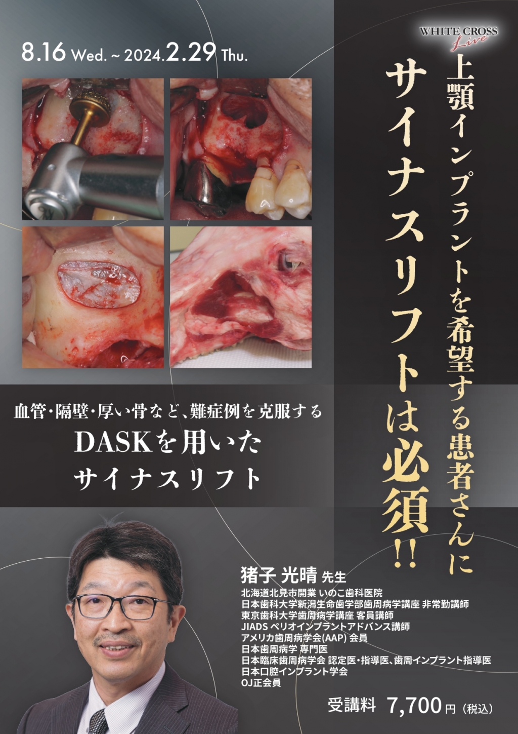 VOD］上顎インプラントを希望する患者さんにサイナスリフトは必須