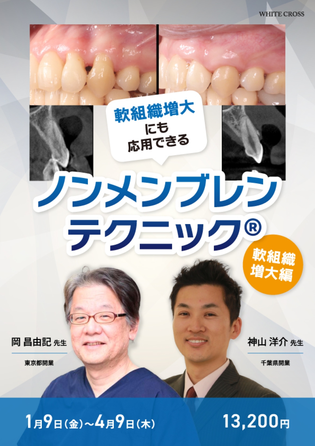 ノンメンブレンテクニック®軟組織増大編の画像です。