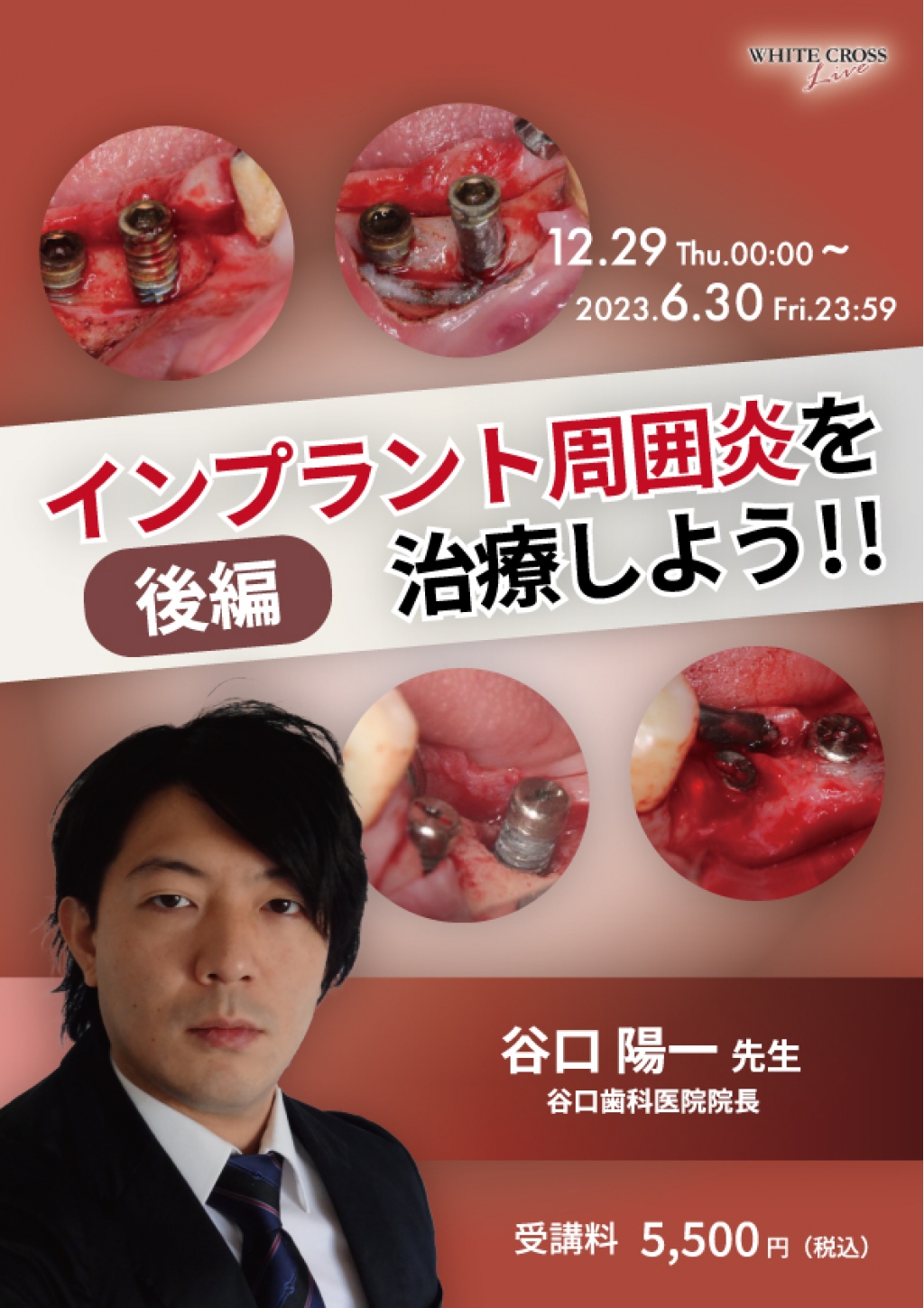 【新品】インプラント周囲炎 予防マニュアル Amazon.co.jp: インプラント周囲炎を治療する: エビデンスに