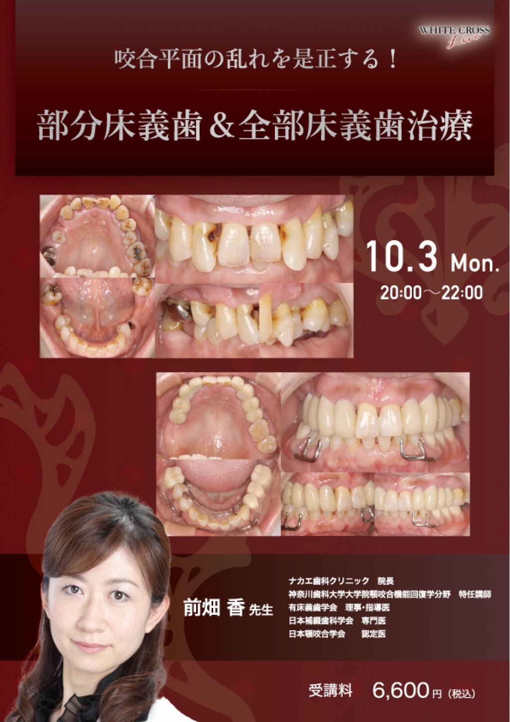 録画配信］咬合平面の乱れを是正する！部分床義歯＆全部床義歯治療