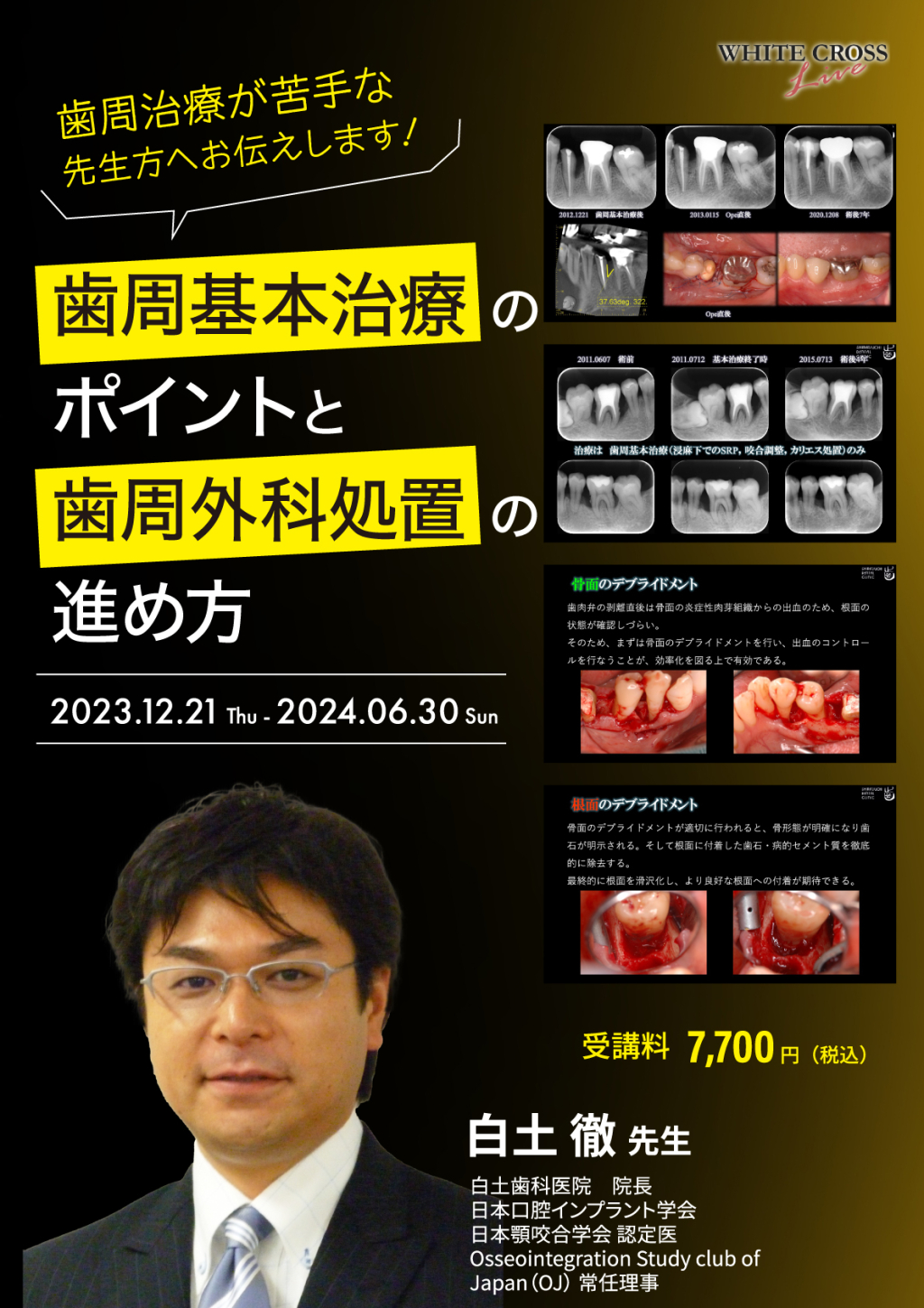 VOD］歯周治療が苦手な先生方へお伝えします！〜歯周基本治療の