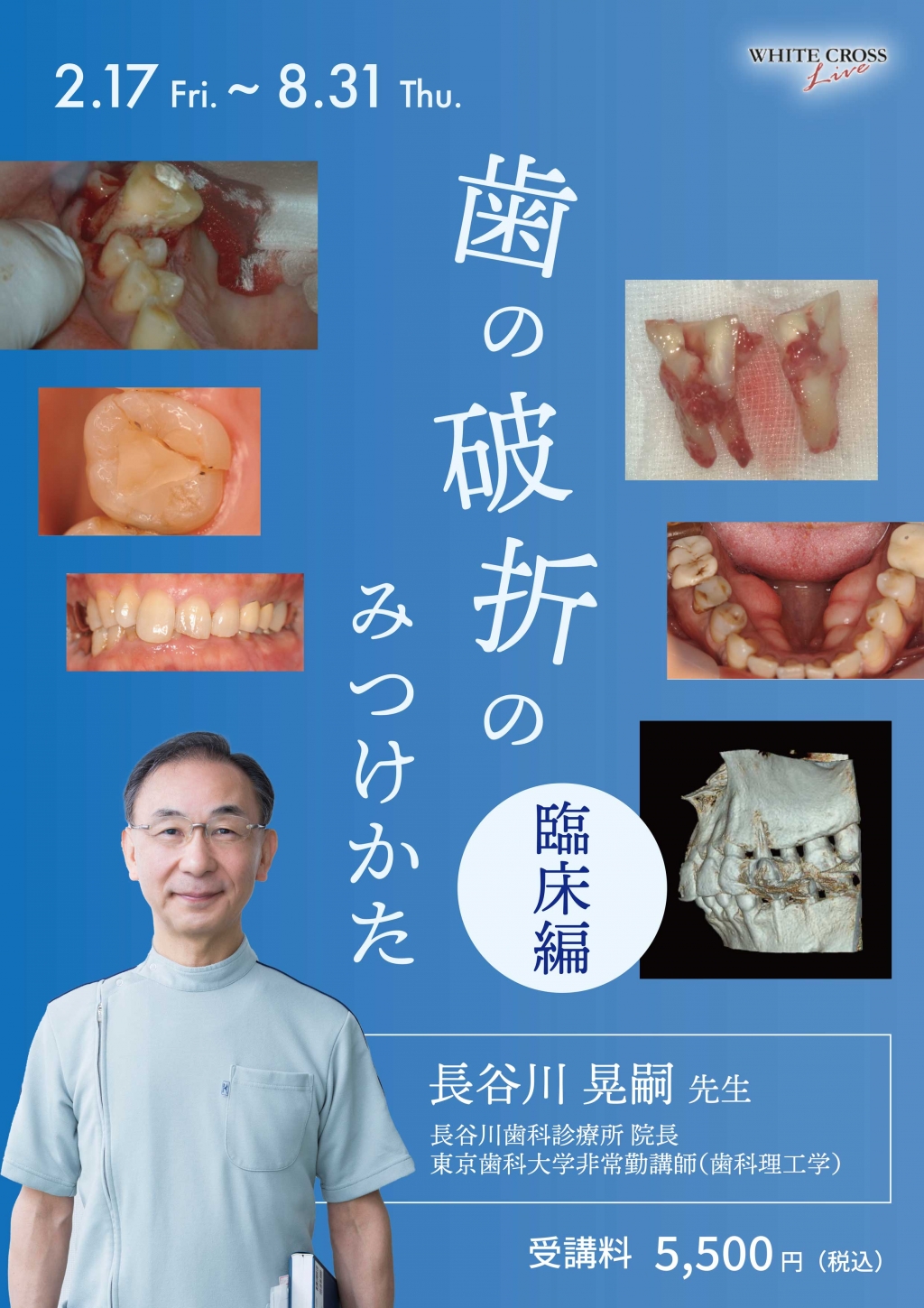VOD］【臨床編】歯の破折のみつけかた | WHITE CROSS