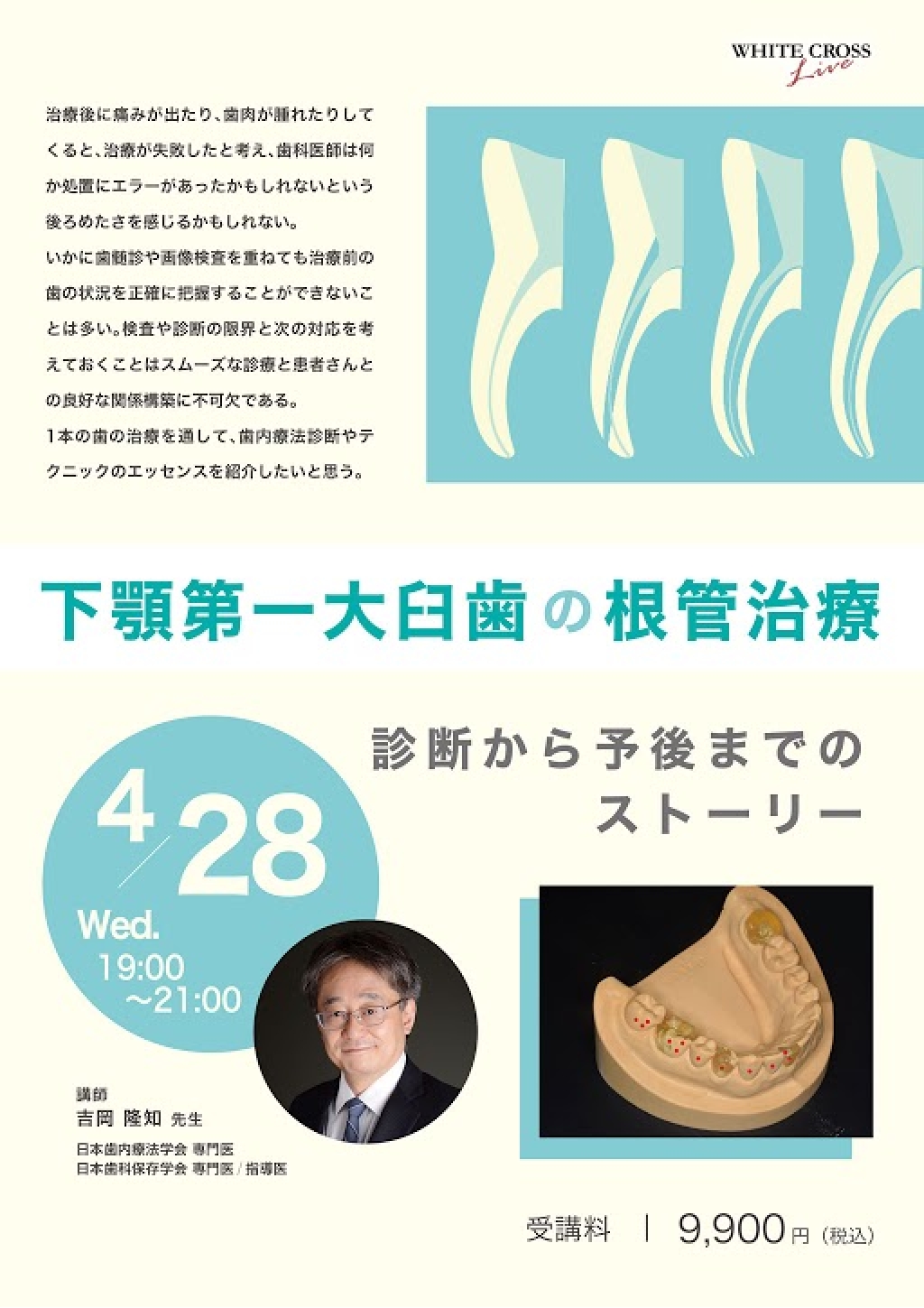 録画配信］下顎第一大臼歯の根管治療 〜診断から予後までのストーリー