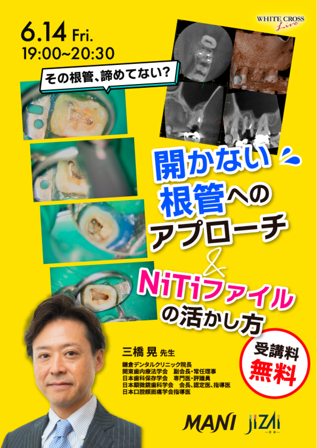 録画配信］その根管、諦めてない？開かない根管へのアプローチ