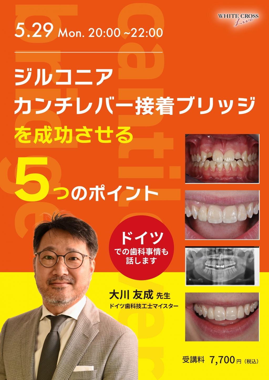 録画配信］ジルコニアカンチレバー接着ブリッジを成功させる「5つ」の