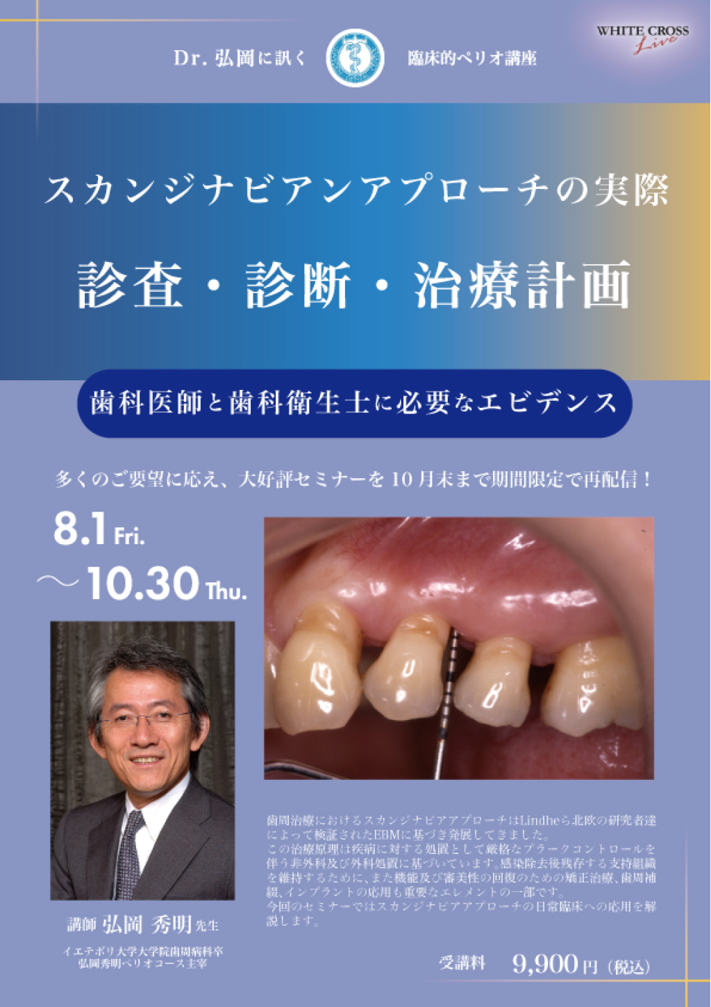 Dr.弘岡に訊く臨床的ペリオ講座 スカンジナビアンアプローチの