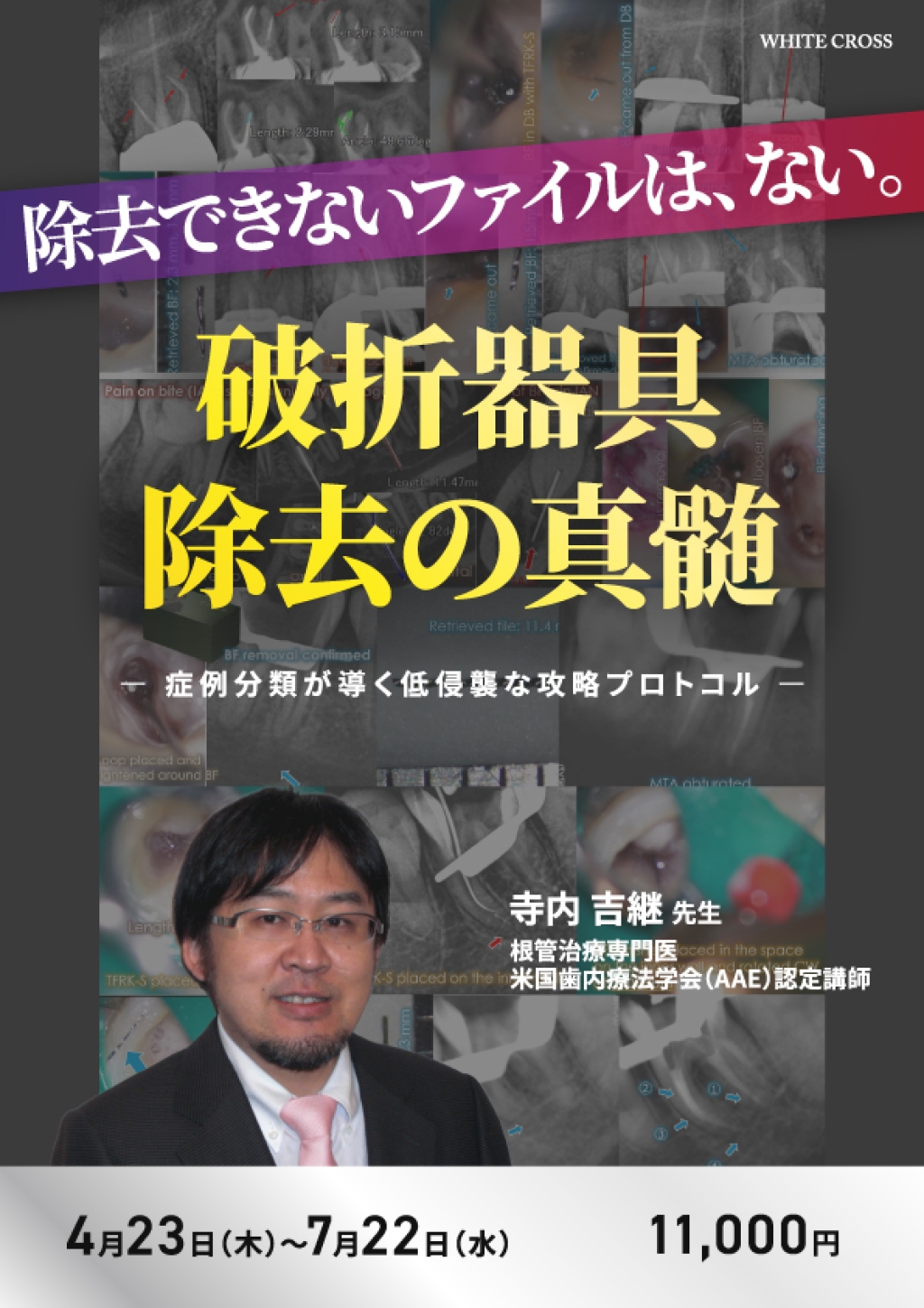 破折器具除去の真髄〜症例分類が導く低侵襲な攻略プロトコル〜 | WHITE