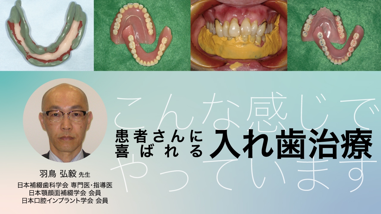 患者さんに喜ばれる入れ歯治療 〜こんな感じでやっています〜 | WHITE