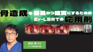 カンタン！確実！骨造成〜臼歯部のオープンバリアメンブレンテクニック