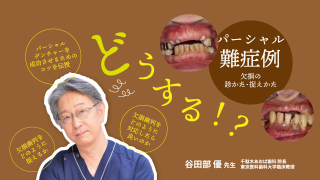 どうする！？パーシャル難症例〜欠損の診かた・捉えかた〜の画像です。