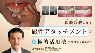確実に患者満足度が上がる！“リンゴ丸かじりができる”全部床義歯～今井